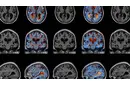 Parkinson Alzheimer Belirtileri ve Tedavisi