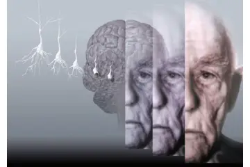 Alzheimer Tedavisi