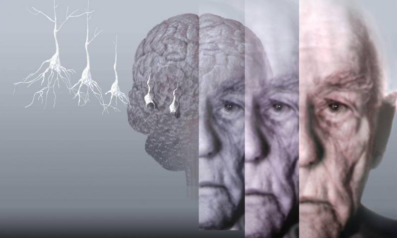 Alzheimer eitleri
